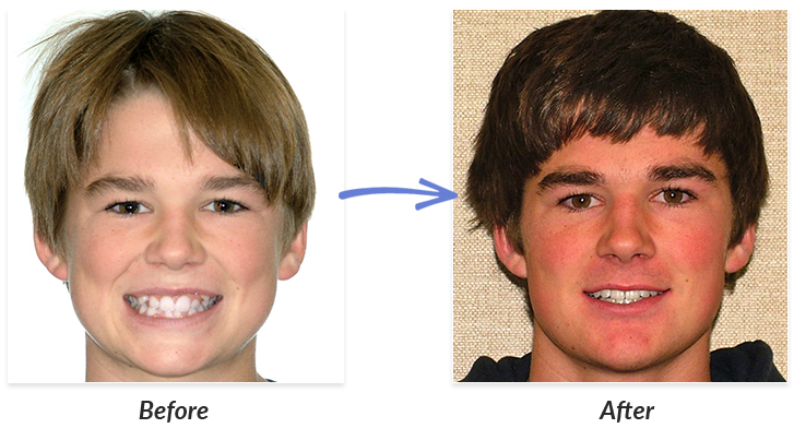 Before And After Braces Photo | DeLurgio Orthodontics : DeLurgio