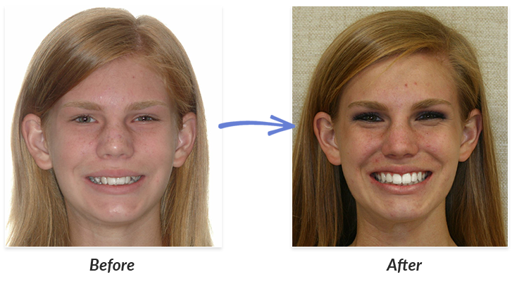 Before And After Braces Photo | DeLurgio Orthodontics : DeLurgio
