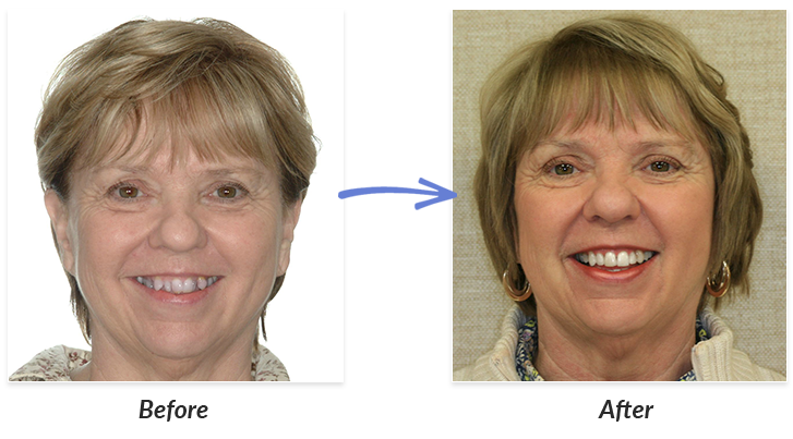 Before And After Braces Adults