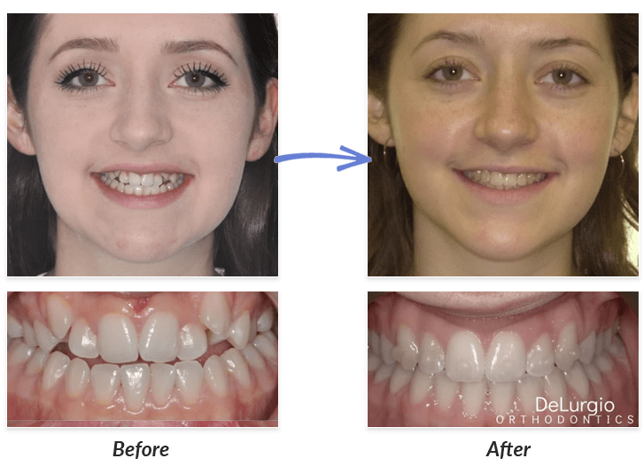 Before & After Braces Photos | DeLurgio Orthodontics : DeLurgio
