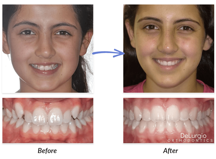 Before & After Braces Photos | DeLurgio Orthodontics : DeLurgio